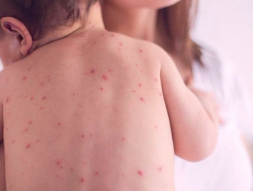 Улаанбурхан өвчний нийт батлагдсан тохиолдол 13.532 болжээ